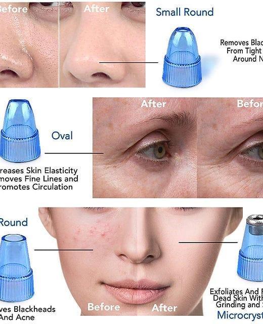 Derma suction roller and black head clear