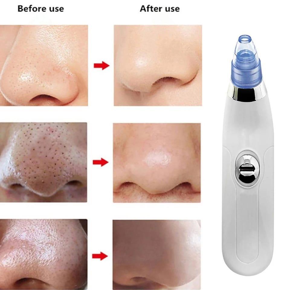 Derma suction roller and black head clear